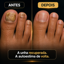 UngiGel: Adesivo reparador de unhas – Tratamento antifúngico avançado
