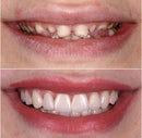 Kit com 2 Placas Dentais de Cerâmica Brancas – PARA TODAS ARCARIAS – Sorriso Perfeito com Praticidade